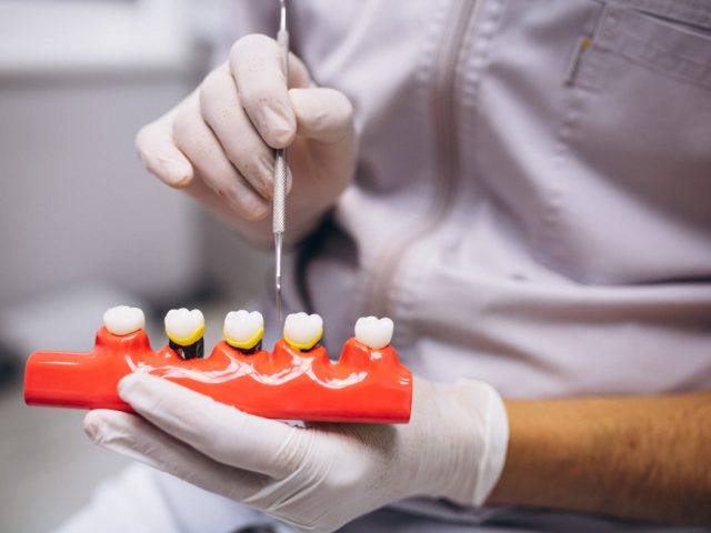 Dentures vs Dental Implants: Which Option Is Right for You?