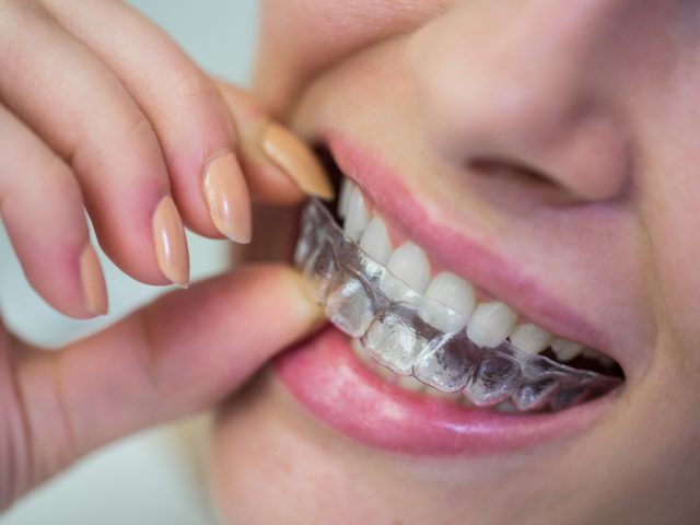 When Should You Choose Clear Aligners in Pune?