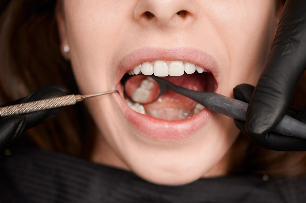 Gums Bleed